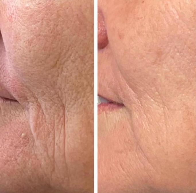 ALMA Harmony XL Pro Laser