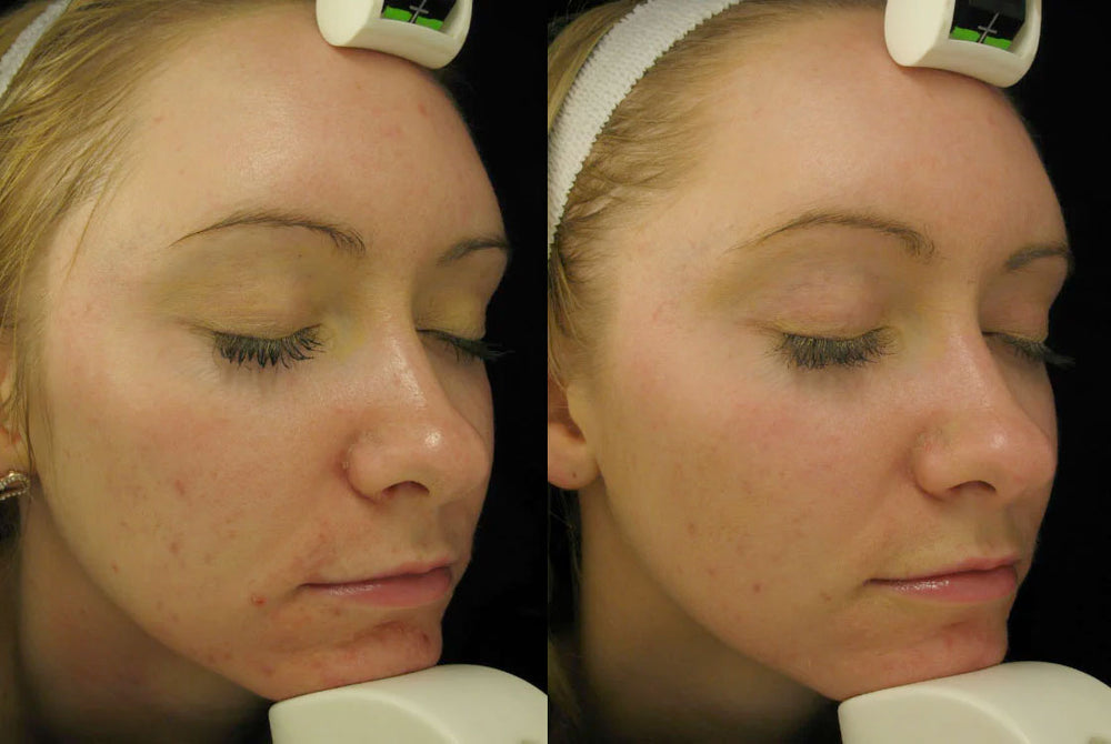 Byonik Laser Facial